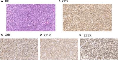 Analysis of the treatment and prognosis of 266 cases of extranodal natural killer/T-cell lymphoma, nasal type in a single medical center
